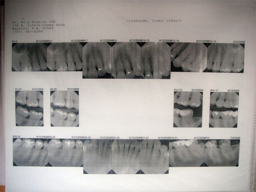 My dental x-rays.