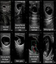 Ultrasound pictures