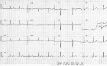 EKG